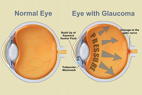 glaucoma featured image